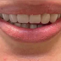 دندان مصنوعی (پروتز)|خدمات آرایشگری و زیبایی|گالیکش, |دیوار