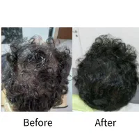 درمان قطعی ریزش مو و رویش مجدد،پی آر پی و مزوتراپی