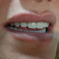 دندان مصنوعی دندانسازی بامجوز رسمی و ۵۰درصدتخفیف|پزشکی|مشهد, پایین خیابان|دیوار