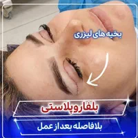 بلفاروپلاستی(جراحی پلک بالا و پایین)توسط چشم پزشک|خدمات آرایشگری و زیبایی|یاسوج, |دیوار