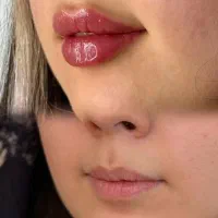 تخفیف ویژه ژل بوتاکس پلاسماژل فیلر توسط پزشک|خدمات زیبایی و سلامت|کرمانشاه, |دیوار