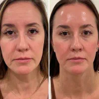 جذب مدل جهت امور زیبایی و فیلر ها