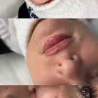 نیارمند مدل برای تزریق لب توسط پزشک