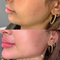 کاشت مو و کاشت ابرو وتزریق ژل و بوتاکس و مزو|خدمات آرایشگری و زیبایی|بهبهان, |دیوار