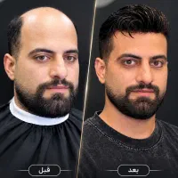 پروتز موی طبیعی ، جایگزین کاشت مو