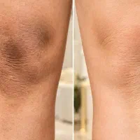 لیزر ،تاتو|خدمات زیبایی و سلامت|کرمانشاه, |دیوار