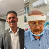 کاشت مو fueپلاس|خدمات آرایشگری و زیبایی|شیراز, قصرالدشت|دیوار