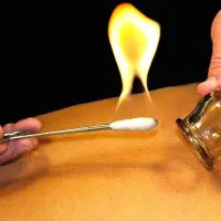 حجامت بادکش ماساژ طب سوزنی زیر نظر پزشک