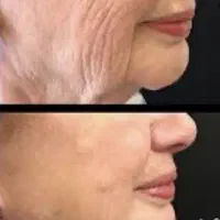 جشنواره تخفیفات ژل،بوتاکس،مزوژل،سلول بنیادی|خدمات زیبایی و سلامت|تهران, قبا|دیوار