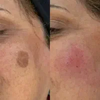 برداشتن خال زگیل میخچه باقیمت فوق العاده توسط پزشک
