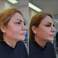 تزریق چربی ژل بوتاکس