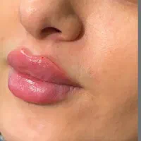 ژل و بوتاکس850