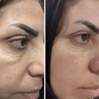 جوانی با بیوممتیک اورجینال/ رفع چروک(بوتاکس خانگی)