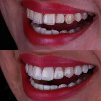 تخفیف‌های ویژه دندانپزشکی عکس تمام فک رایگان|خدمات آرایشگری و زیبایی|فردیس, شهرک هفده شهریور|دیوار