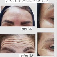 بوتاکس و فیلر صورت