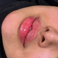 تزریق ژل و بوتاکس و مزو پزشک متخصص و مجرب