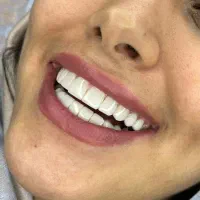 کامپوزیت زیبایی دندان