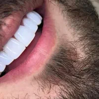 آموزش حضوری و مجازی ونیر کامپوزیت دندان