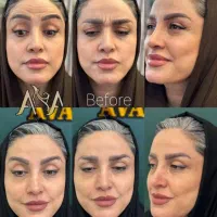 بوتاکس مصپورت اصلی(ماندگاری طولانی مدت)بانوان