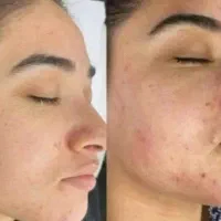 پوستی شاداب میخوای بدون لک یا جای،جوش