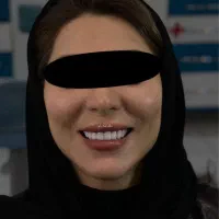 کامپوزیت زیبایی دندان