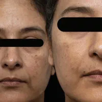 لیزر موهای زائد الکس پلاس (شاتی) بدون ژل/درمان لک|خدمات آرایشگری و زیبایی|رشت, گلسار|دیوار