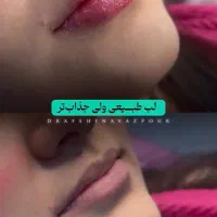 تزریق ژل بوتاکس تمام قسط