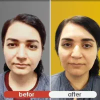 بلفاروپلاستی مدل بخیه لیزری،بوکال فت،ساکشن،سانترال|خدمات آرایشگری و زیبایی|تهران, هفت حوض|دیوار