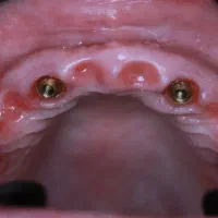 دندانپزشکی،ایمپلنت،اوردنچر با اقساط دو ساله|خدمات آرایشگری و زیبایی|اهر, |دیوار