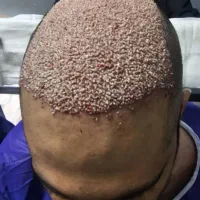 کاشت مو و ابرو پرتراکم و طبیعی