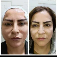 مینی لیفت صورت با جراحی سرپایی و بی حسی موضعی
