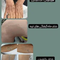 ریمو تتو وکک و مک با کیوسوییچ در کلینیک توسط پزشک|خدمات آرایشگری و زیبایی|قم, بکایی|دیوار