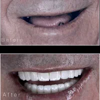 ایمپلنت یک روزه دیجیتالی