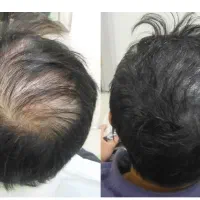 با تکنیک میکرواسکالپ،کم پشتی مو دیگه دیده نمیشه|خدمات آرایشگری و زیبایی|شاهین‌شهر, فردوسی|دیوار