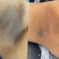 وایتینگ کربن تراپی کک مک  حذف تاتو