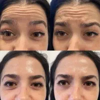 بوتاکس تخفیفف