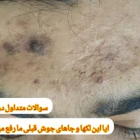 جای جوش و ابله و لک جوش|خدمات آرایشگری و زیبایی|دورود, |دیوار