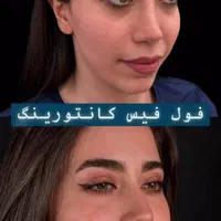 تزریق فیلر ژل/بوتاکس/prp پوست مو/پی آر‌پی/مزوتراپی|خدمات آرایشگری و زیبایی|کرج, گوهردشت|دیوار