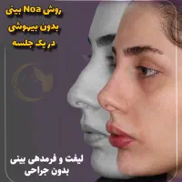 آف رینوپلاستی بینی بدون عمل جراحی NOA پزشک زیبایی