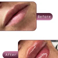 تزریق فیلر زیر چشم|خدمات آرایشگری و زیبایی|تهران, جردن|دیوار