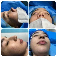 جراحی زیبایی بینی و ترمیمی|خدمات آرایشگری و زیبایی|قائمشهر, |دیوار