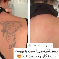 لیزر تتو با کیوسوئیچ ۲۰۲۵