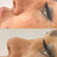 تزریق ژل وبوتاکس تخفیف ویژه|خدمات آرایشگری و زیبایی|تهران, خانی آباد نو شمالی|دیوار