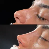 عمل زیبایی بینی ابدوپلاستی  پروتز سینه در اهواز