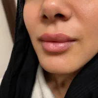تزریق بوتاکس فیلر ژل لب در پاکدشت توسط پزشک