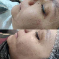 پاکسازی پوست با بهترین متریال|خدمات آرایشگری و زیبایی|مشهد, کوی المهدی|دیوار