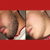 رویش ریش با ضمانت