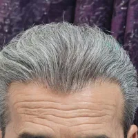 کاشت مو VIP با امکان اقساط ۱۰ ماهه