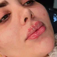 تزریق فیلر بادی بدن۱۲۰هزار|خدمات آرایشگری و زیبایی|جوانرود, |دیوار