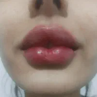 تزریق چربی ساکشن چربی ژل بوتاکس مزو چال گونه|خدمات آرایشگری و زیبایی|قم, بنیاد|دیوار